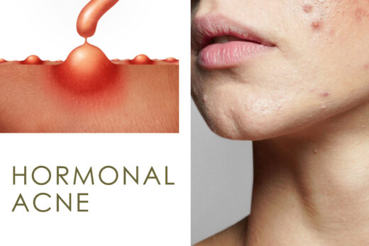 Cover image for 'Hormonal Acne Ultimate Guide' post, featuring a woman's face with acne, and acne spots creating a question mark.