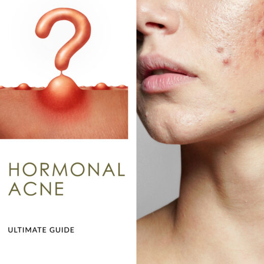 Cover image for 'Hormonal Acne Ultimate Guide' post, featuring a woman's face with acne, and acne spots creating a question mark.