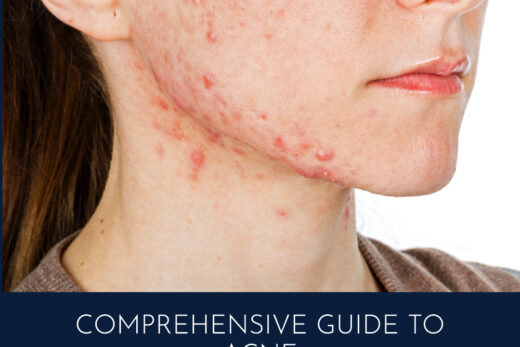 Image of a woman with acne breakout on her face. titled "comprehensive guide to acne"