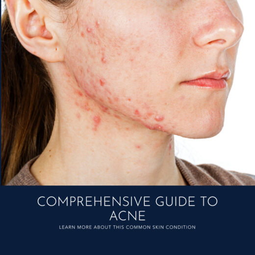 Image of a woman with acne breakout on her face. titled "comprehensive guide to acne"